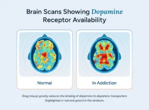 Brain Scans Showing Dopamine Receptor Availability