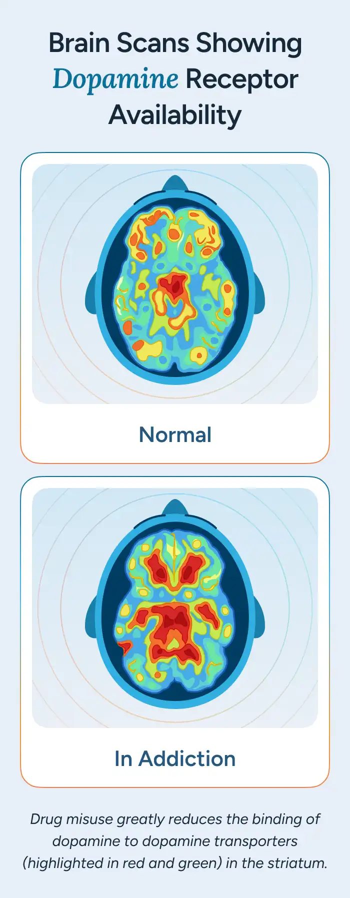 Brain Scans Showing Dopamine Receptor Availability