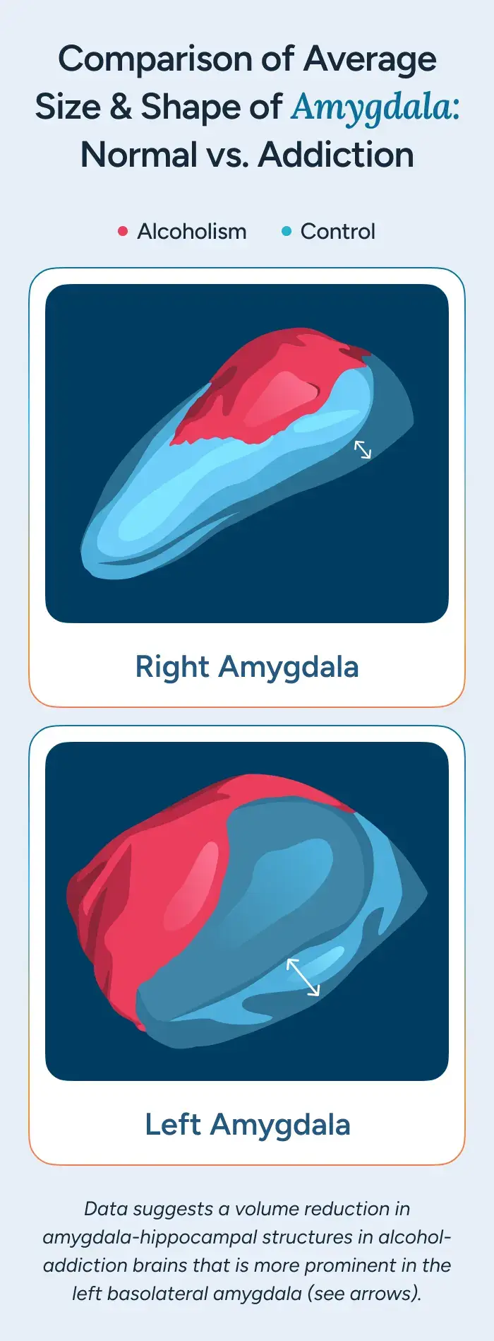 Comparison of Average Size & Shape of Amygdala: Normal vs. Addiction
