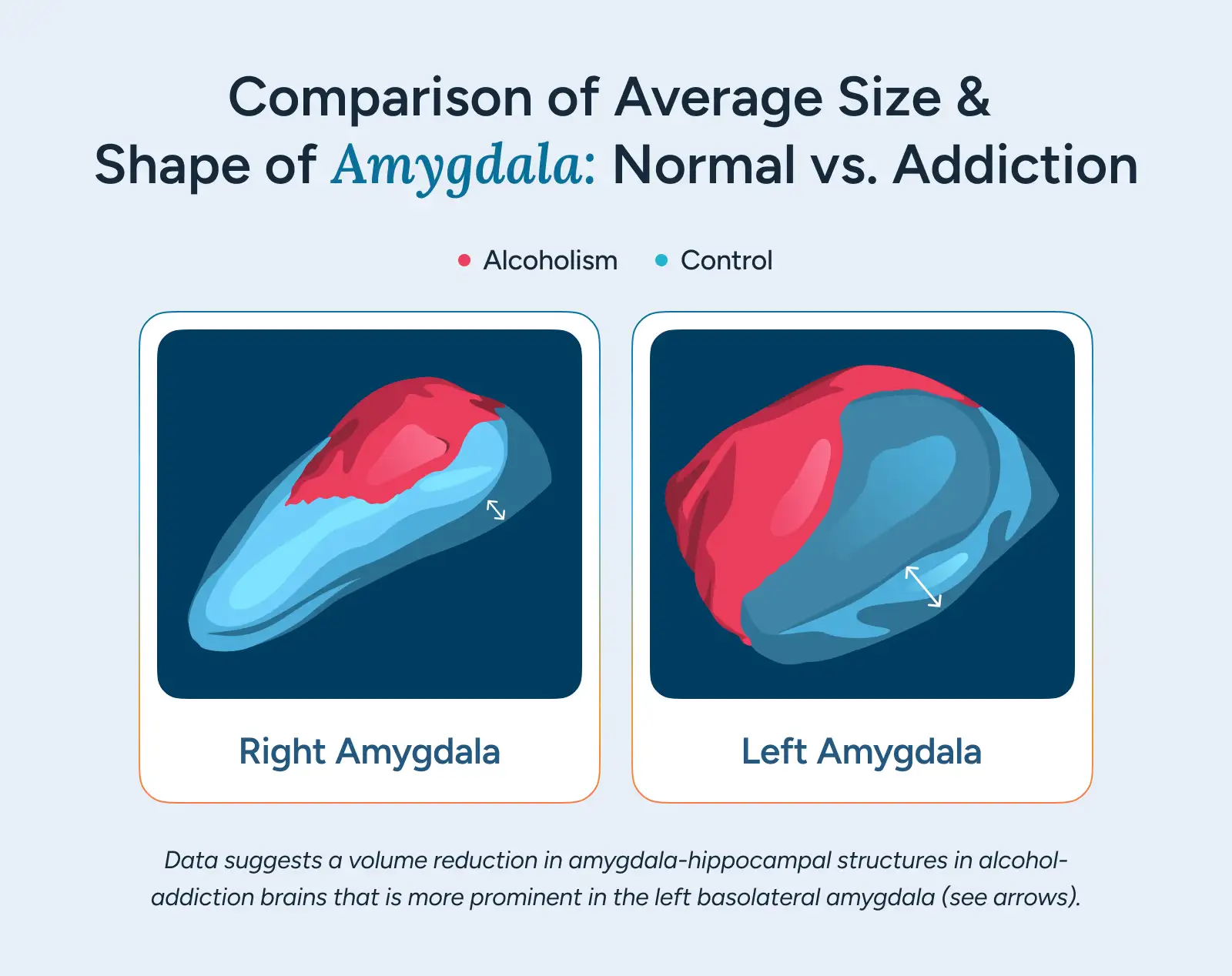 Comparison of Average Size & Shape of Amygdala: Normal vs. Addiction