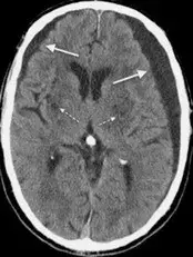 The mortality rate for untreated DTs is 15-35%