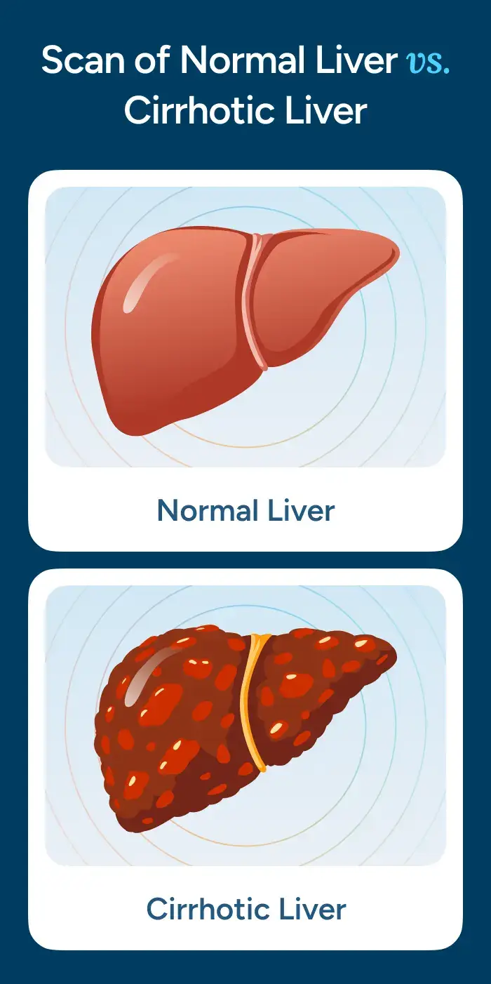 Scan of Normal Liver vs. Cirrhotic Liver