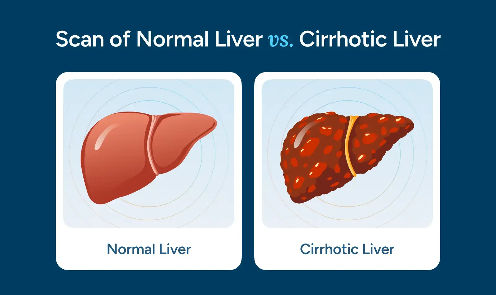 Scan of Normal Liver vs. Cirrhotic Liver