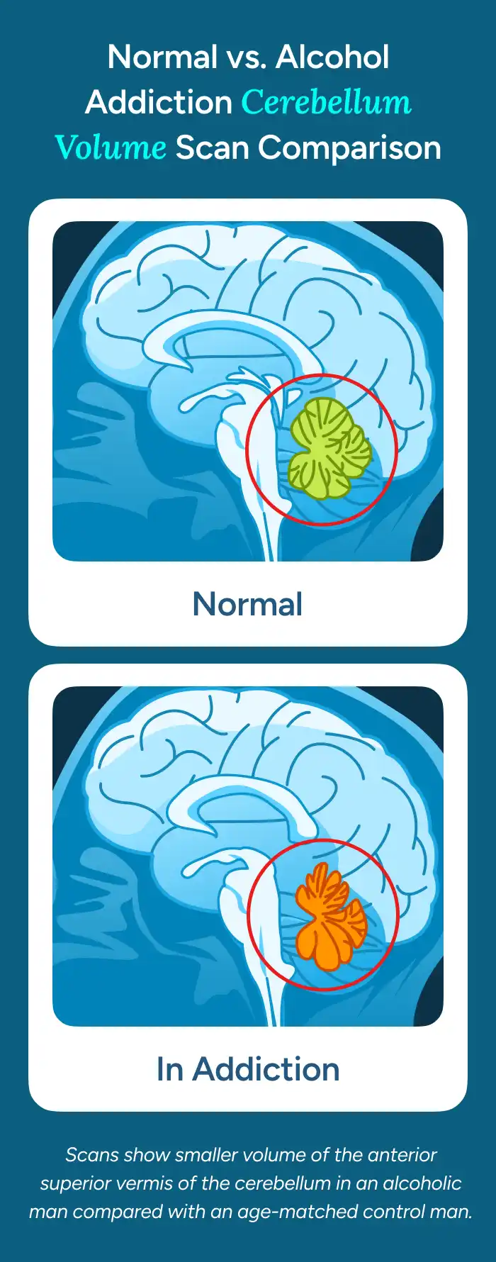 Normal vs. Alcohol Addiction Cerebellum Volume Scan Comparison
