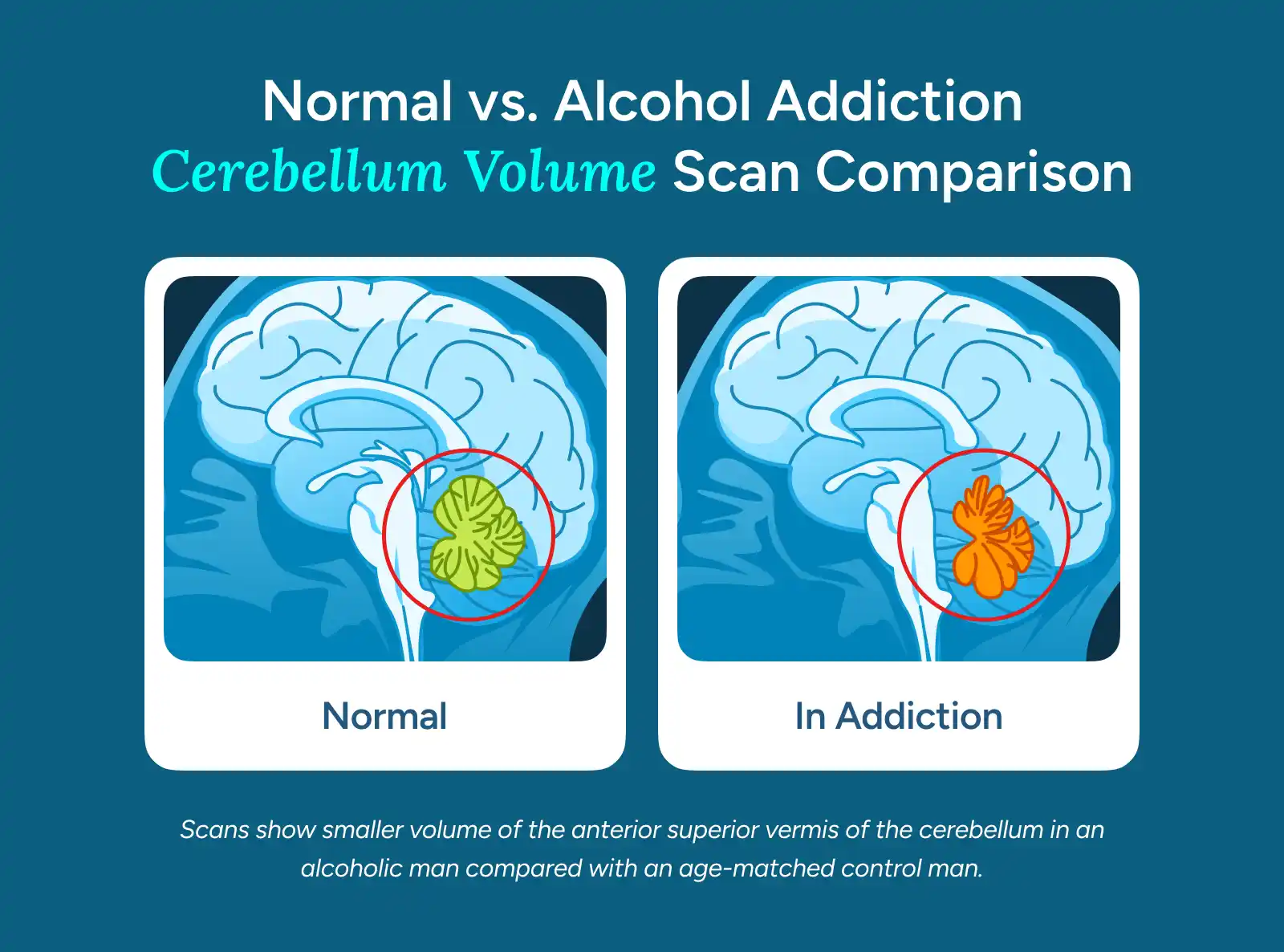 Normal vs. Alcohol Addiction Cerebellum Volume Scan Comparison